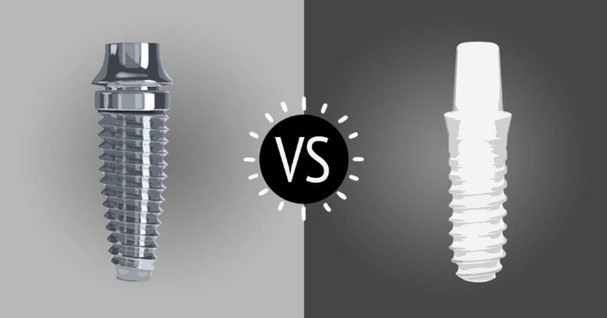 implant-comparison