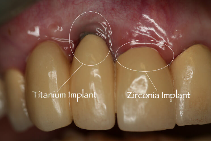 titanium-zirconia-implants